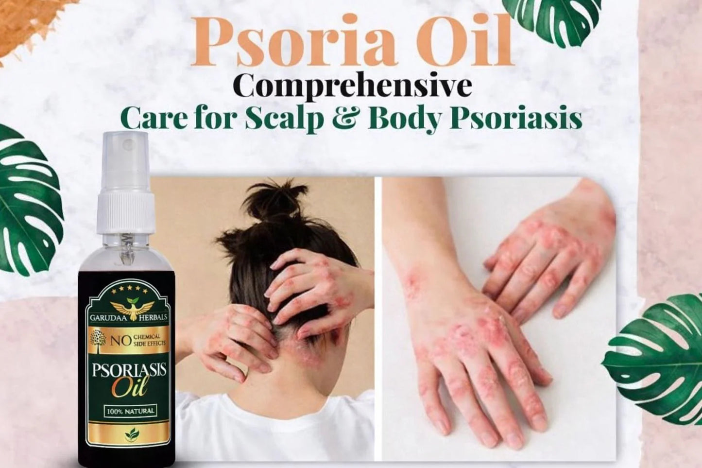 Garuda Herbal Psoriasis Oil-Advanced Psoriasis Clearing Oil